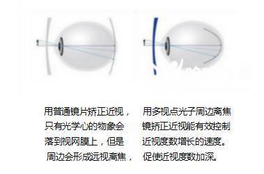 孩子眼睛度数持续加深？光学镜片选择与科学防控是关键